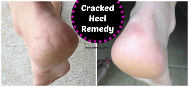 hydrogen peroxide cracked heels remedy a before and after photo